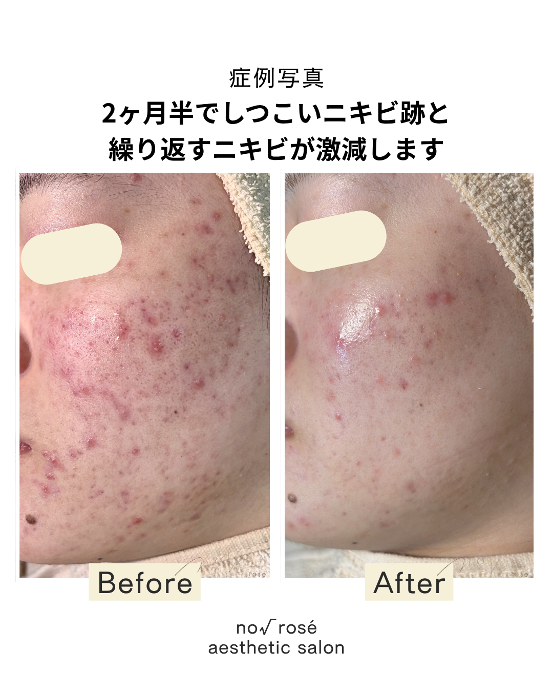 no√roseでのニキビケア 2ヶ月半の変化